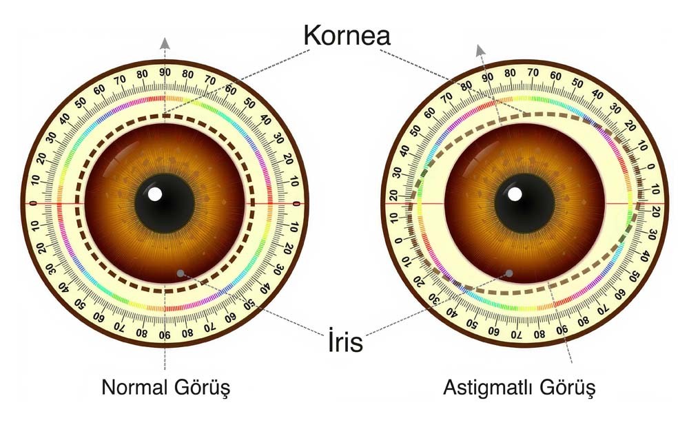 astigmat