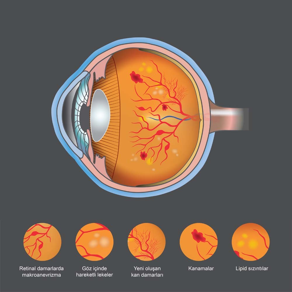 diyabetik retinopati