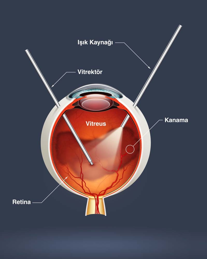 diyabetik retinopati göz şekeri belirtileri