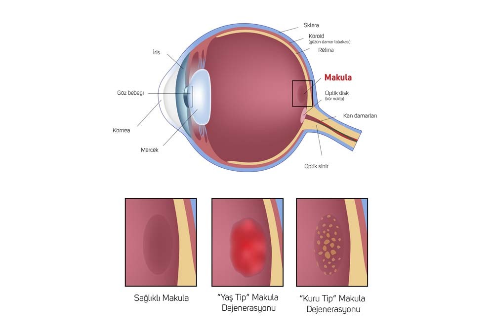 sarı nokta hastalığı makula dejenerasyonu