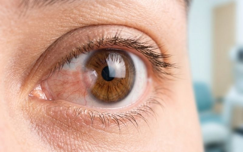 7 Hayati Gerçek: Pterjium (Göz Eti Büyümesi) Ameliyatsız Geçer mi? (2026 Rehberi)