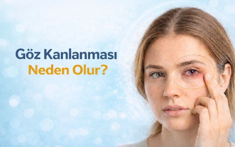 Göz Kanlanması Neden Olur? Tedavisi ve Ne Zaman Doktora Gitmelisiniz