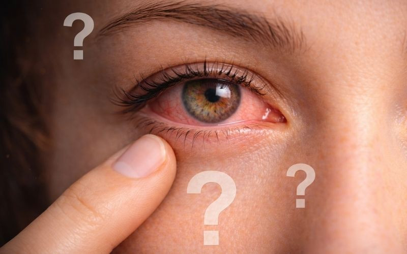 Göz Kanlanması Neden Olur? Tedavisi ve Ne Zaman Doktora Gitmelisiniz