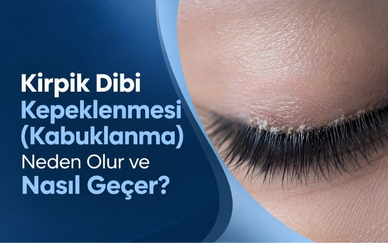 Kirpik Dibi Kepeklenmesi (Kabuklanma) Neden Olur ve Nasıl Geçer?